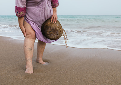 Woman on the beach with varicose veins
