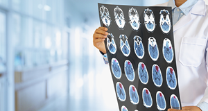 A doctor holding an MRI scan of a skull tumor