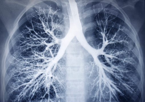 X-Rays of lungs
