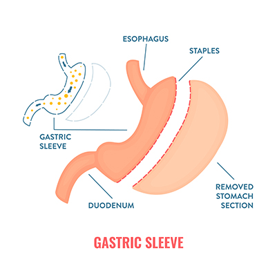 gastric sleeve pic