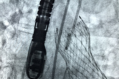TAVR
